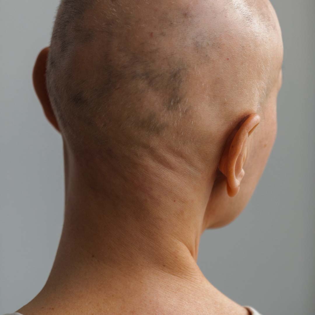 Alopecia Treatment