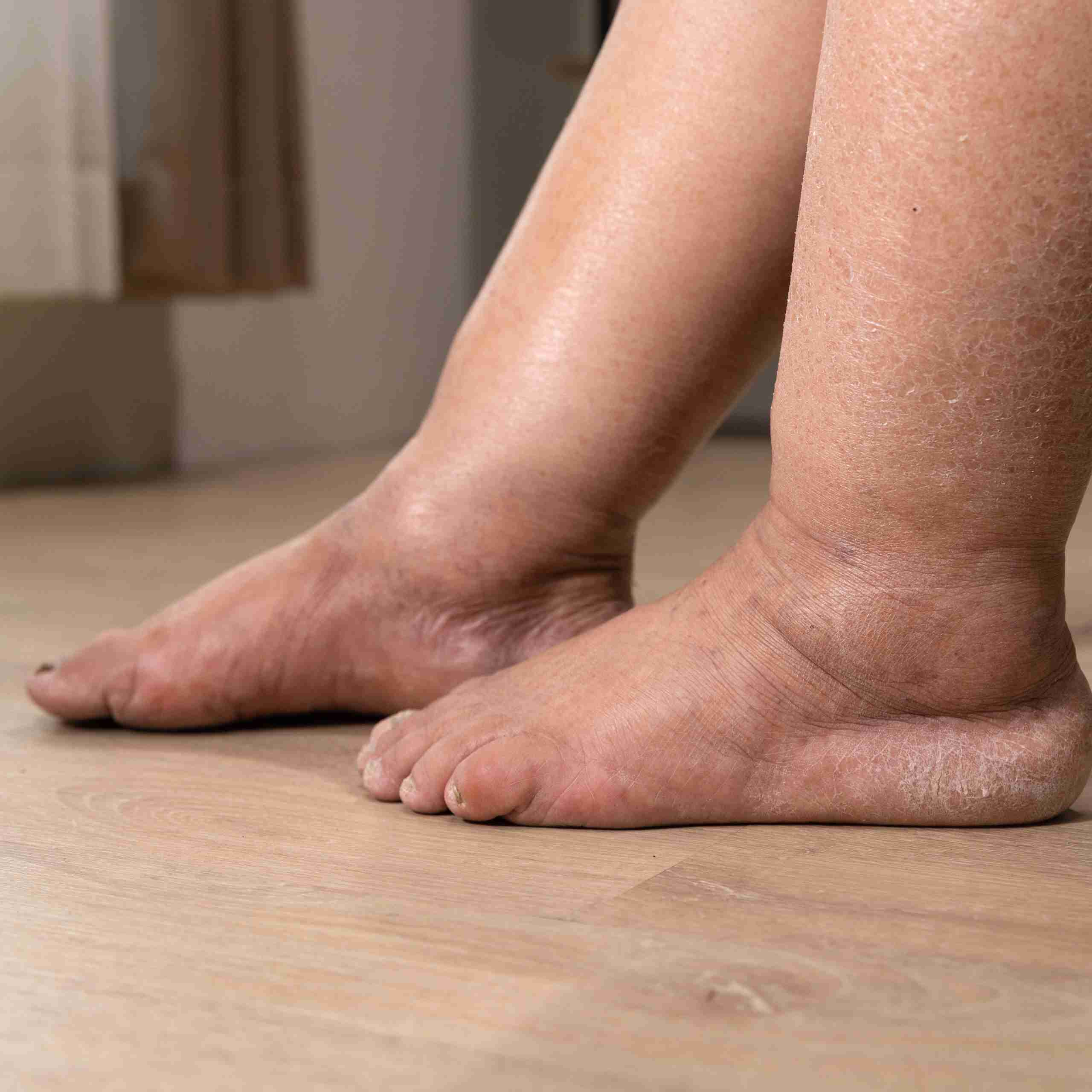 Lymphatic Drainage for Edema