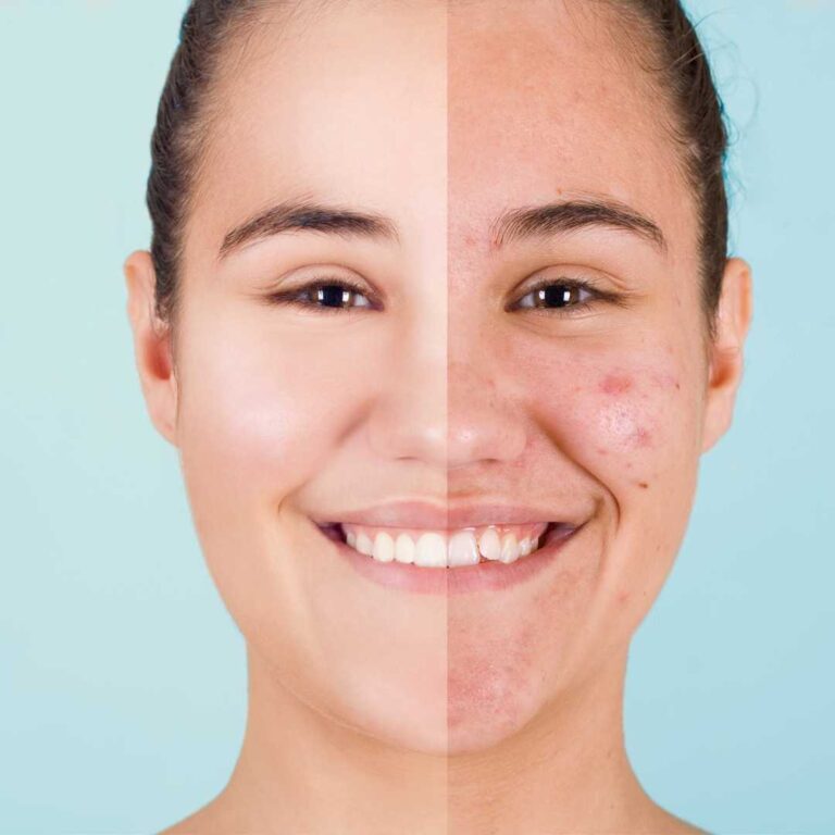 Acne Before After