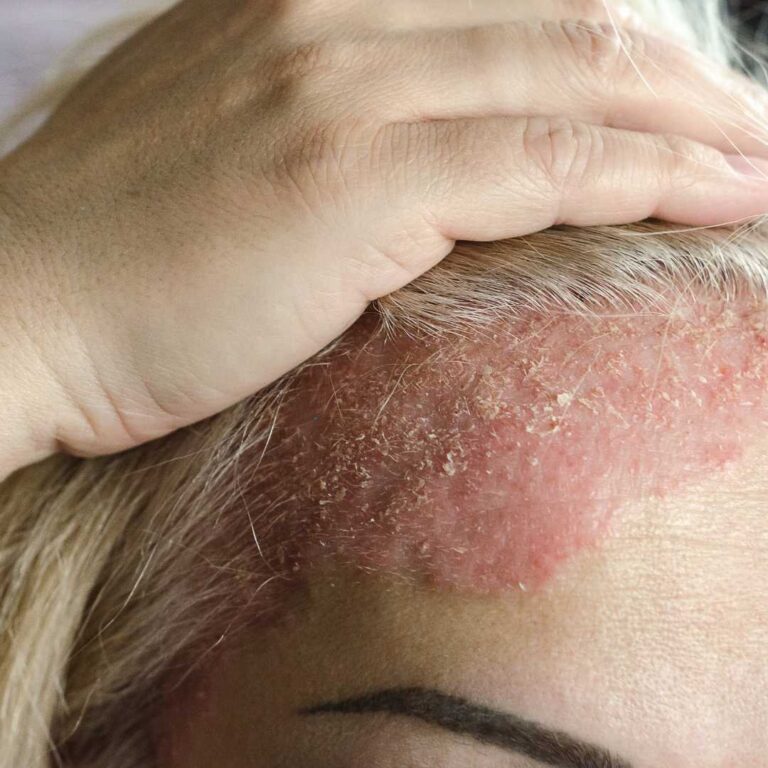 Scalp Psoriasis