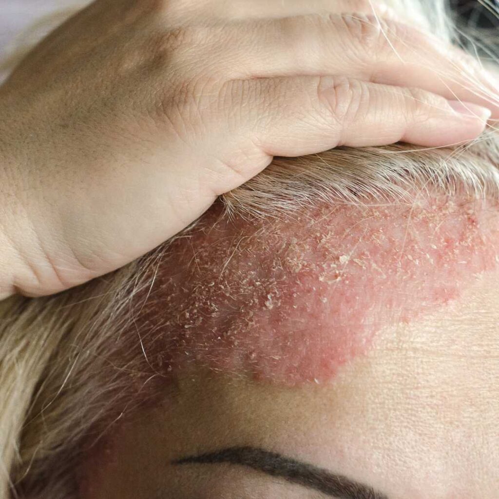 Duricef Rashes Dermatitis - Causes, Types & Treatments in Abu Dhabi | EDCC