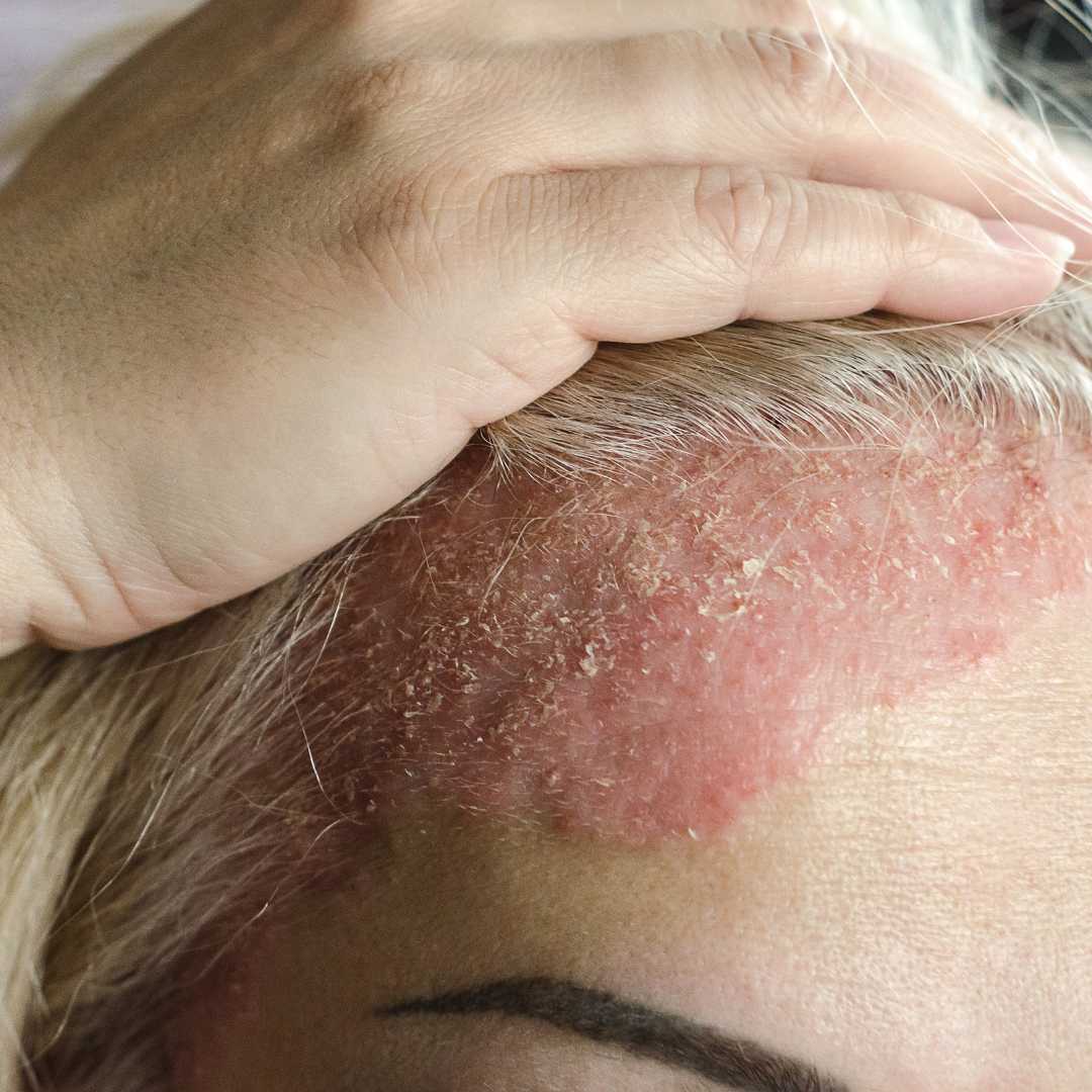 Mild Seborrheic Dermatitis Scalp SEBORRHEIC DERMATITIS OF THE SCALP