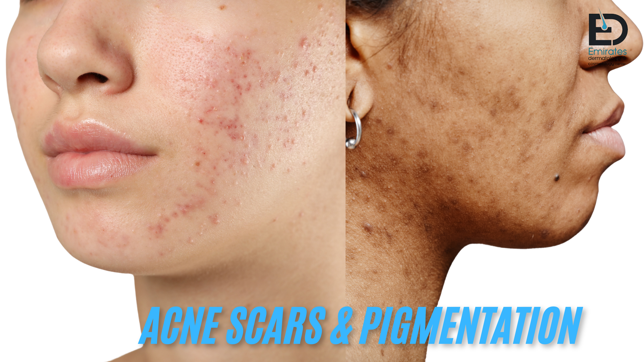 Acne Scars & Pigmentation