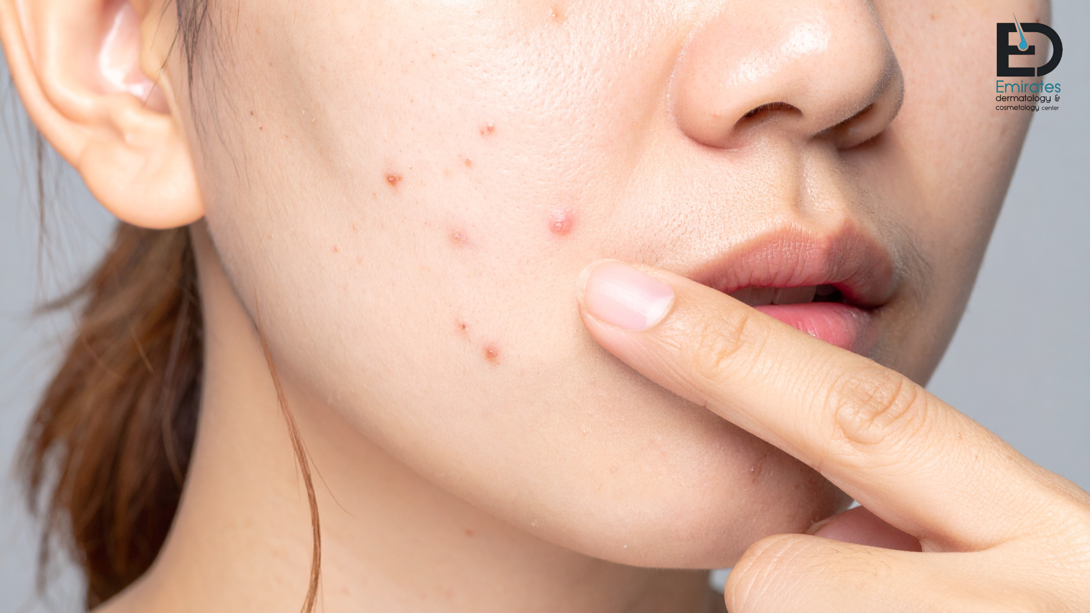 Correct Acne Diagnosis